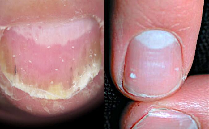 psoriasis-des-ongles-sur-les-mains-et-les-pieds-causes-diagnostic-et